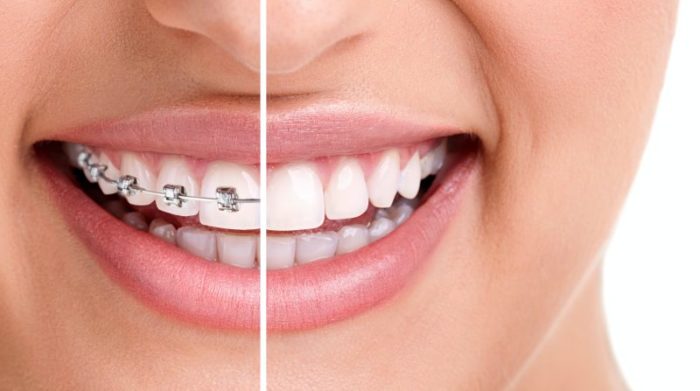 Aparaty ortodontyczne, rodzaje i dlaczego warto