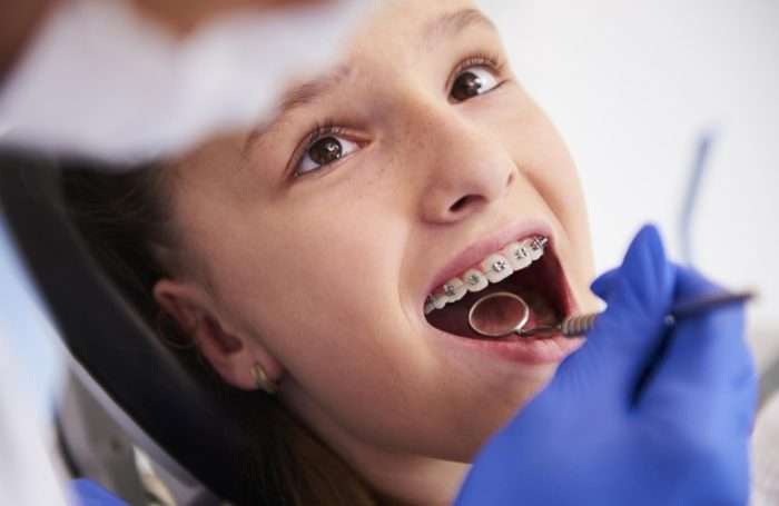 Jak przygotować się do założenia aparatu ortodontycznego?