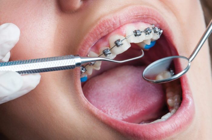 Próchnica u pacjenta noszącego aparat ortodontyczny – profilaktyka, leczenie