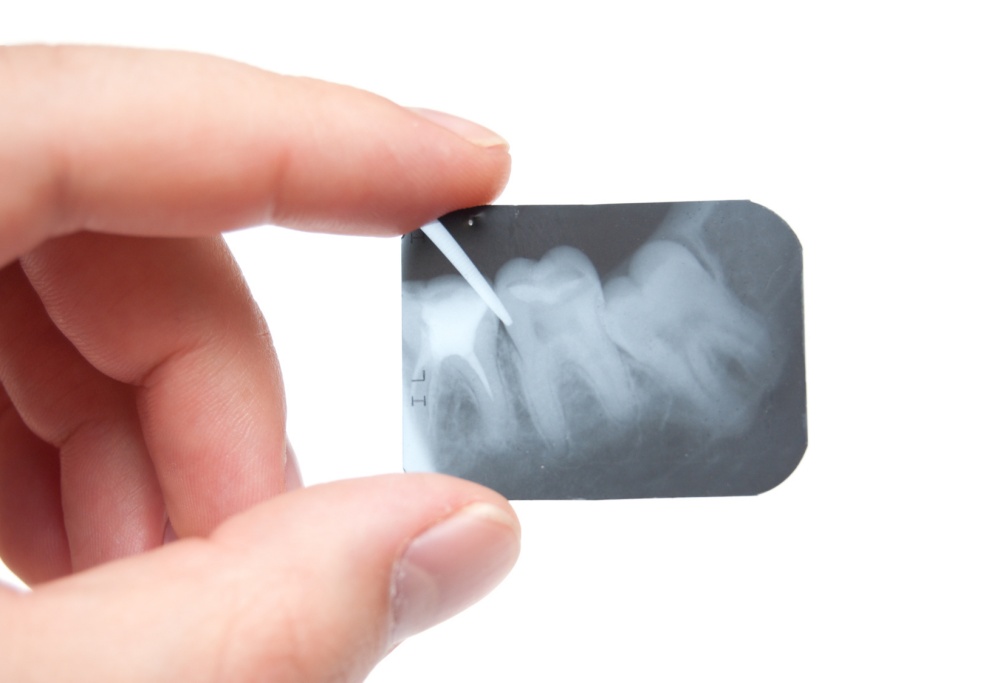 RTG zębów – czym jest i jak się przygotować?