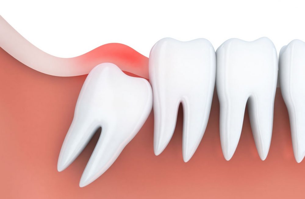 Zęby zatrzymane – kiedy trzeba je usunąć?