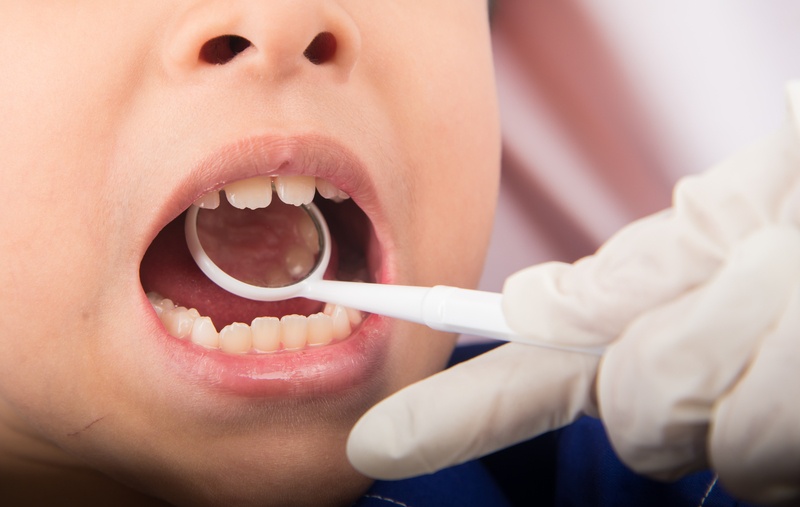 Lapisowanie zębów u dzieci – dlaczego leczenie mleczaków jest ważne?
